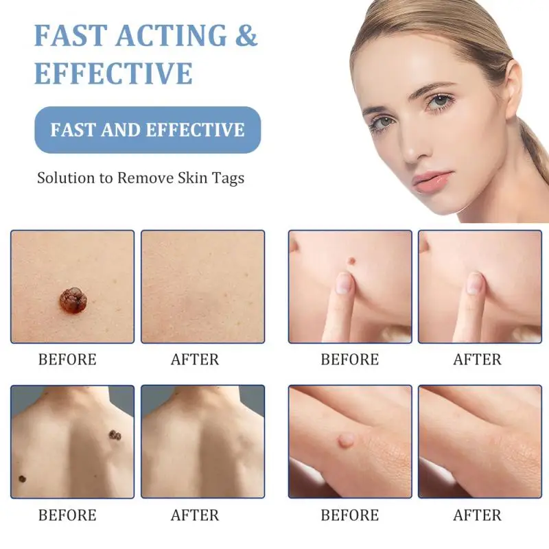 

Auto Skin Tag Removal Pen Safety Painless Mole Wart Nevus Dark Spot Remover Skin Tag Remover Kit Skin Care Tools Dropshipping