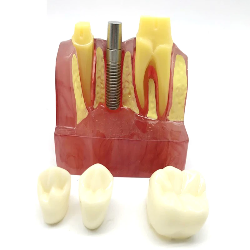 

Dental Materials 4 Times Implant Interpretation Model Implant Nail Oral Teaching Doctor-Patient Communication