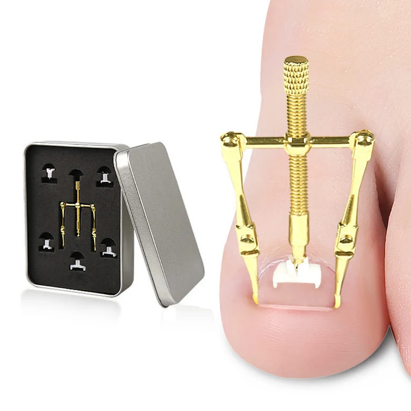 Набор медицинских корректирующих фиксаторов для вросших ногтей