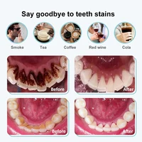 Ультразвуковой прибор для удаления зубного камня#2