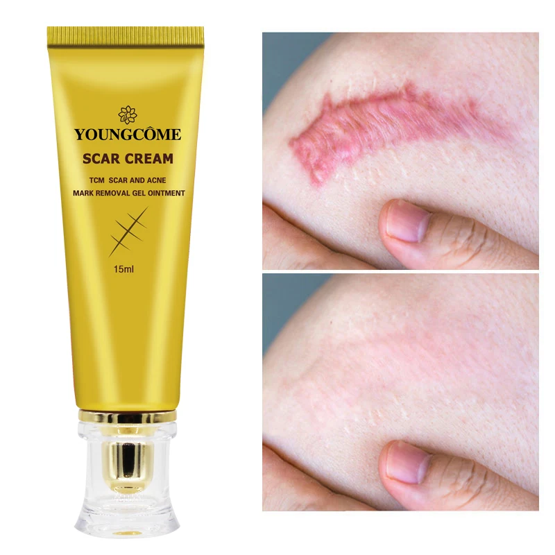 

Acne Scar Removal Cream Skin Care Stretch Marks Treatment Pimples Spots Repair Gel Whitening Moisturizer Smooth Beauty Cosmetics