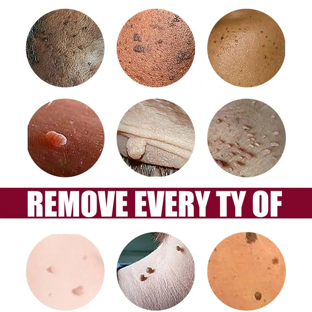 

Comfortable Practical Acne Remove Skin Tag Body Wart Sticker Mini Wart Decal Painless for Female