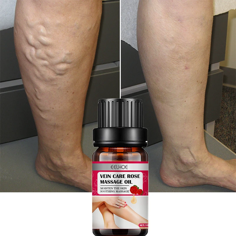 Varicose Veins Removal Essential Oil Cream For Feet Dilated Vasculitis Phlebitis Spider Leg Pain Relief Personal Health Care10ml