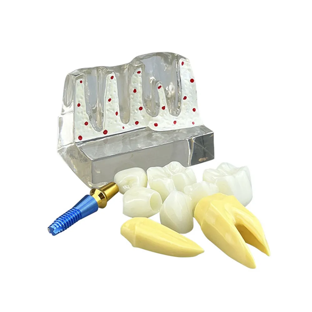 Тренировочная модель для зубного импланта 4-кратный анализ имплантов коронного