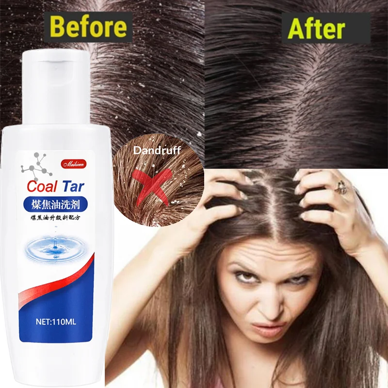 

1% Coal Tar Lotion, Deep Cleansing, Anti-dandruff Anti-itch Oil Control Shampoo To Improve Dandruff Scalp Itching Shampoo