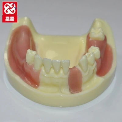 

Lack of dental implants model simulation Missing teeth free shipping