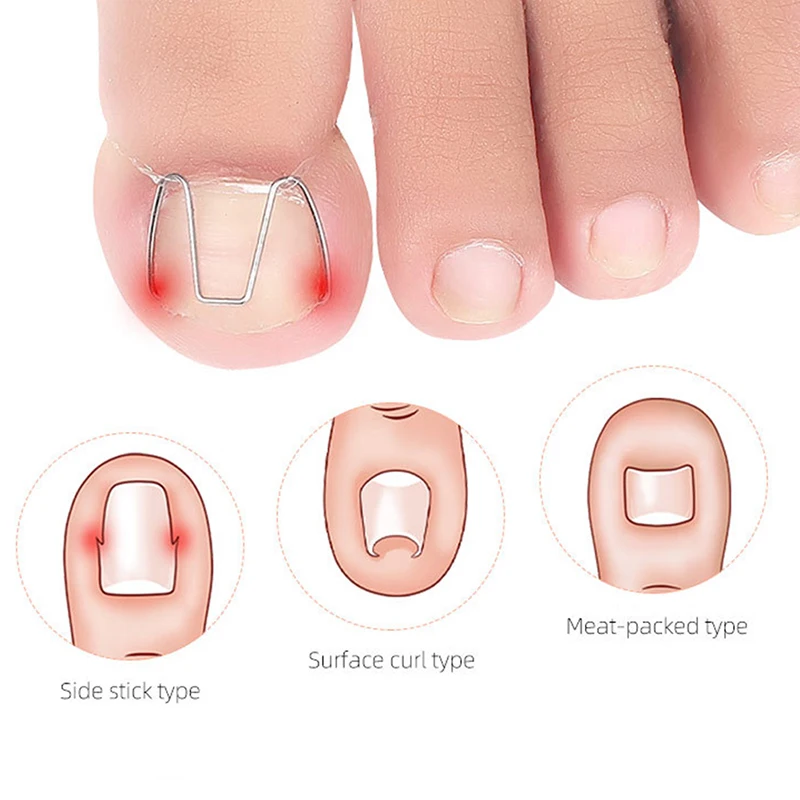 

6pcs/pack Toenail Nail Ingrown Clip Nail Art Ingrown Toe Nail Correction Tool Orthosis Paronychia Pedicure Foot Tool Corrector