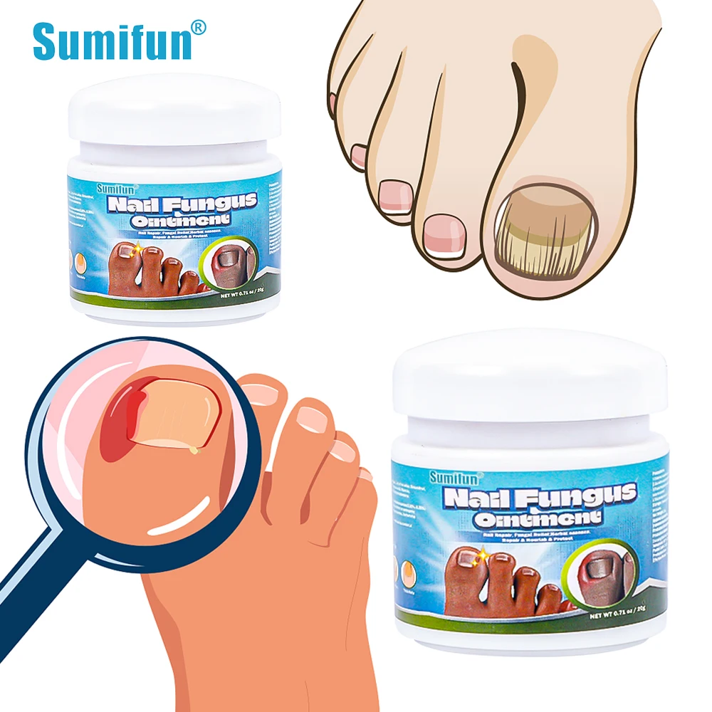 

Sumifun Toe Paronychia Treatment Cream Herbal Nail Fungus Removal Ointment Onychomycosis Repair Anti Infection Foot Care Tools