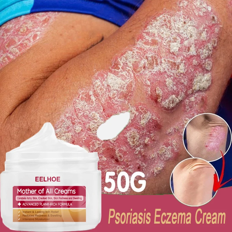 

50g Psoriasis Dermatitis Eczematoid Eczema Moss Ointment Anti-Itch Chinese Herb Medical Relieve Itching Skin Care Cream