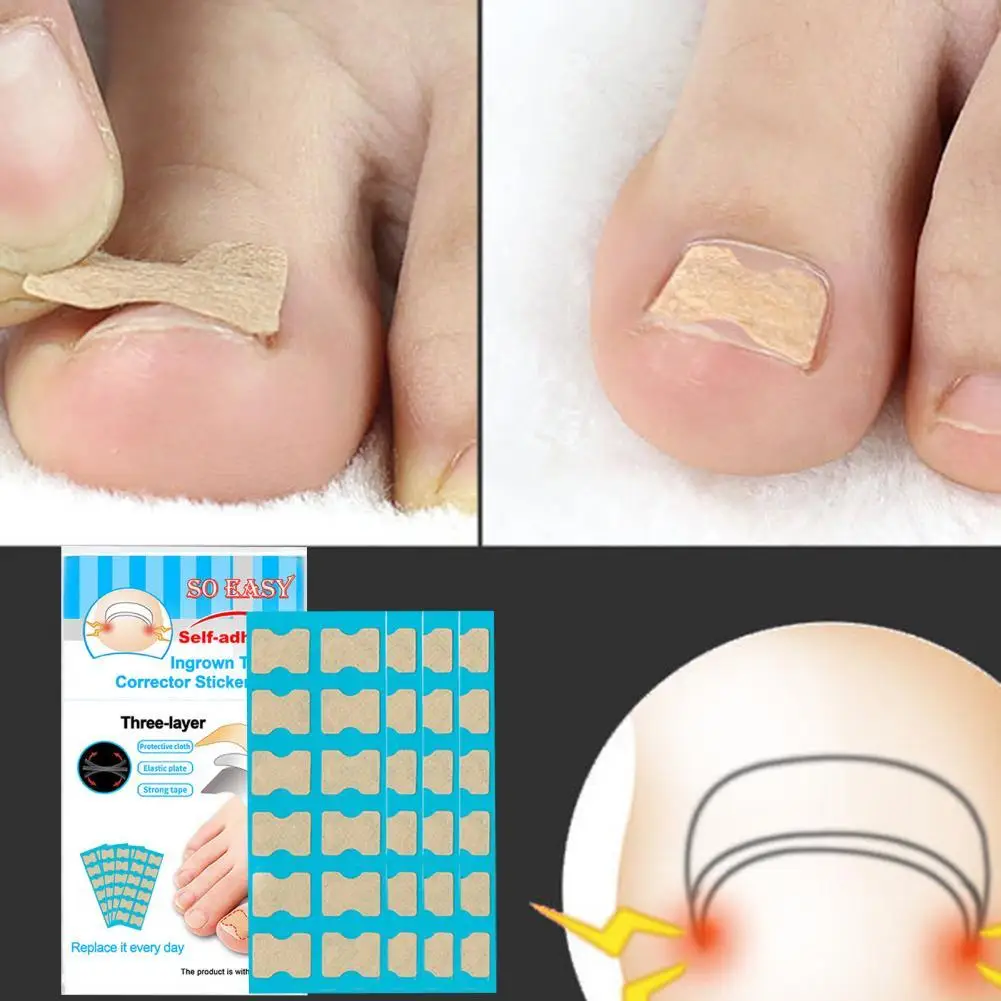 

Pedicure Care Versatile Pedicure Care Toenail Ingrown Patch Lightweight Toenail Ingrown Patch Strong Tape for Office