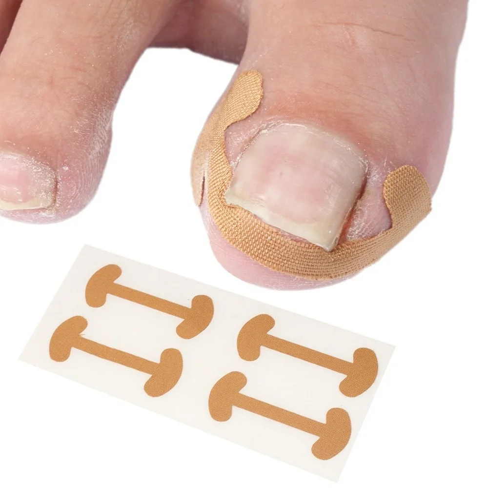 

1Set Ingrown Toenail Corrector Sticker Paronychia Treatment Corrector Pedicure Foot Orthodontic Toe Thumb Nail Care Patches