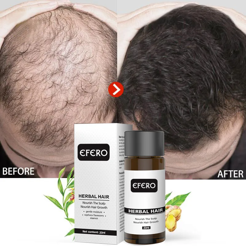 Hair Growth Oil Hair Loss Serum Fast Hair Growth Essential Oils Man Woman Dense Hair Restoration Anti-Hair Loss Hair Care 20ml