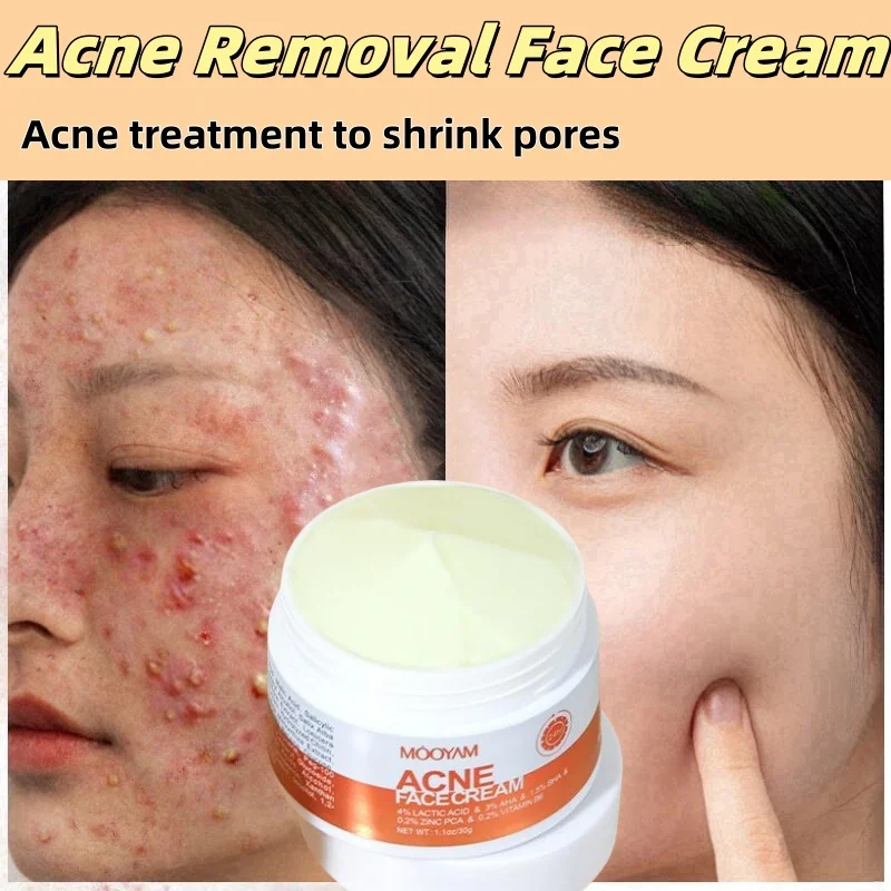 Травяной крем для лица от прыщей гель против лечение шрамов сужение пор