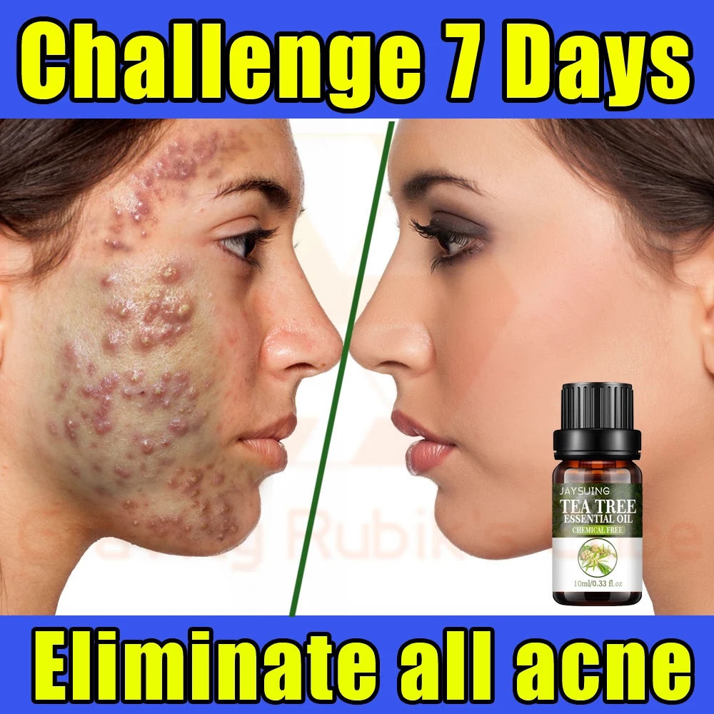 Сыворотка от прыщей эффективно удаляет акне следов шрамов восстанавливает кожу -