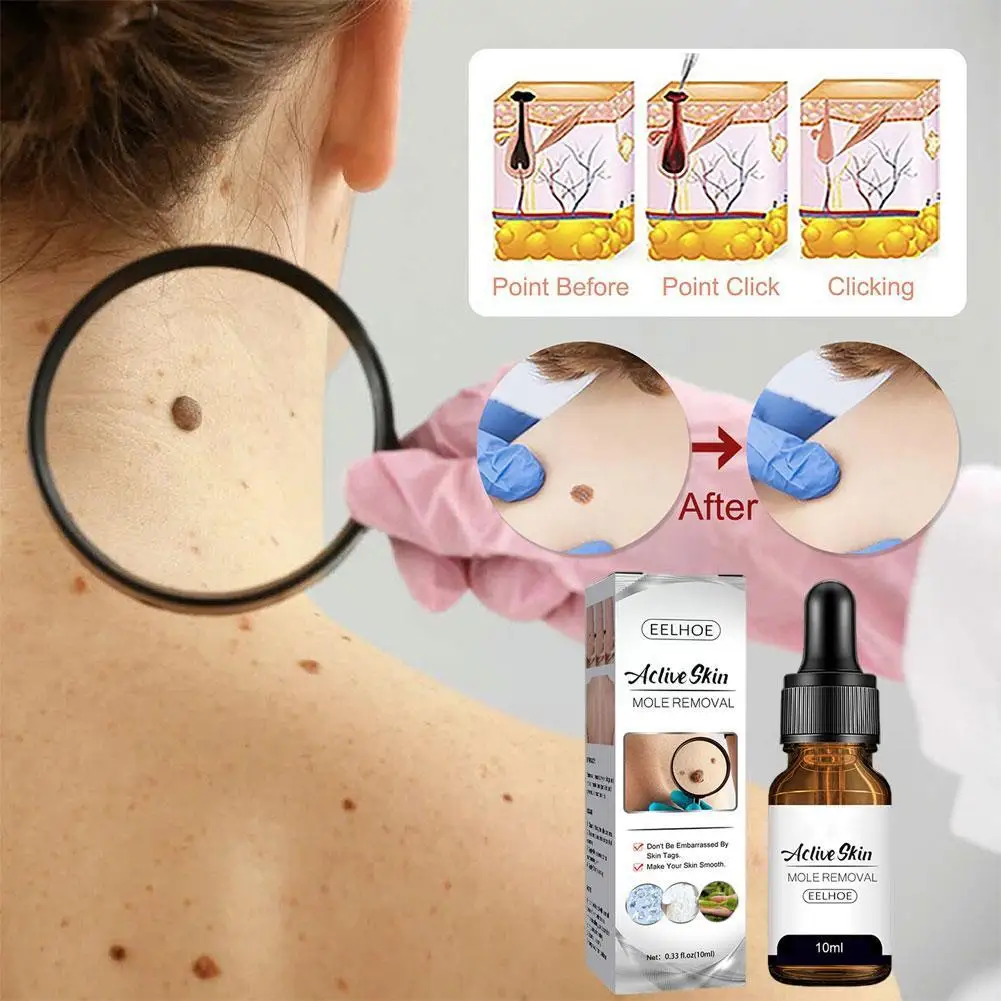 

10ml Wart And Mole Removal Essence Skin Wart Skin Tag Removal Skin Removal Treatment Essence Care Papillomas Genital Liquid