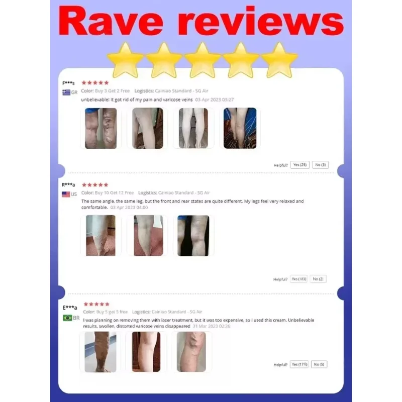 Облегчение варикозного расширения вен ног васкулит флебит форма паука