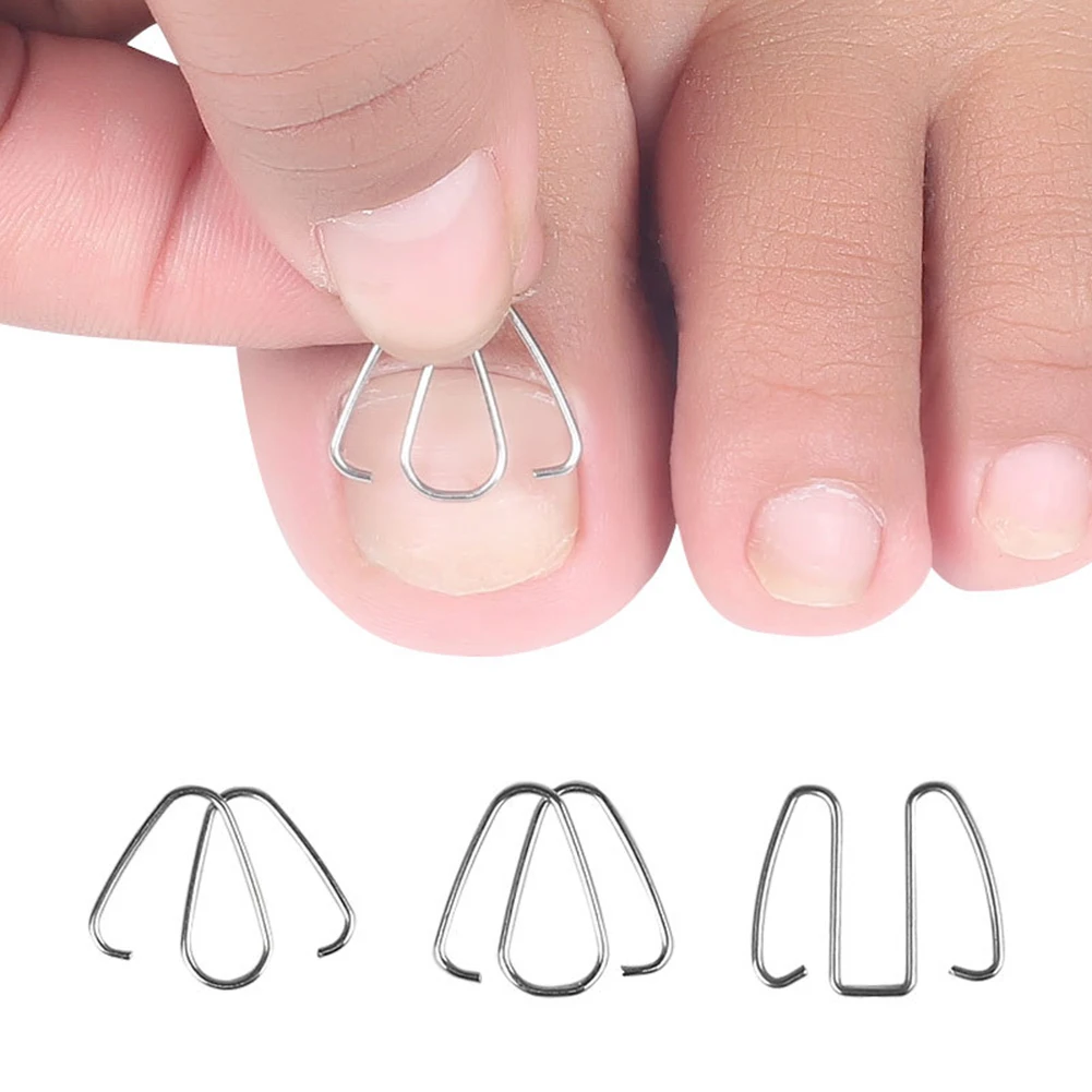 

Toe Nail Correction Tools Orthosis Paronychia Treatment Clip Nail Ingrown Clip Orthosis Paronychia Foot Pedicure Health Care