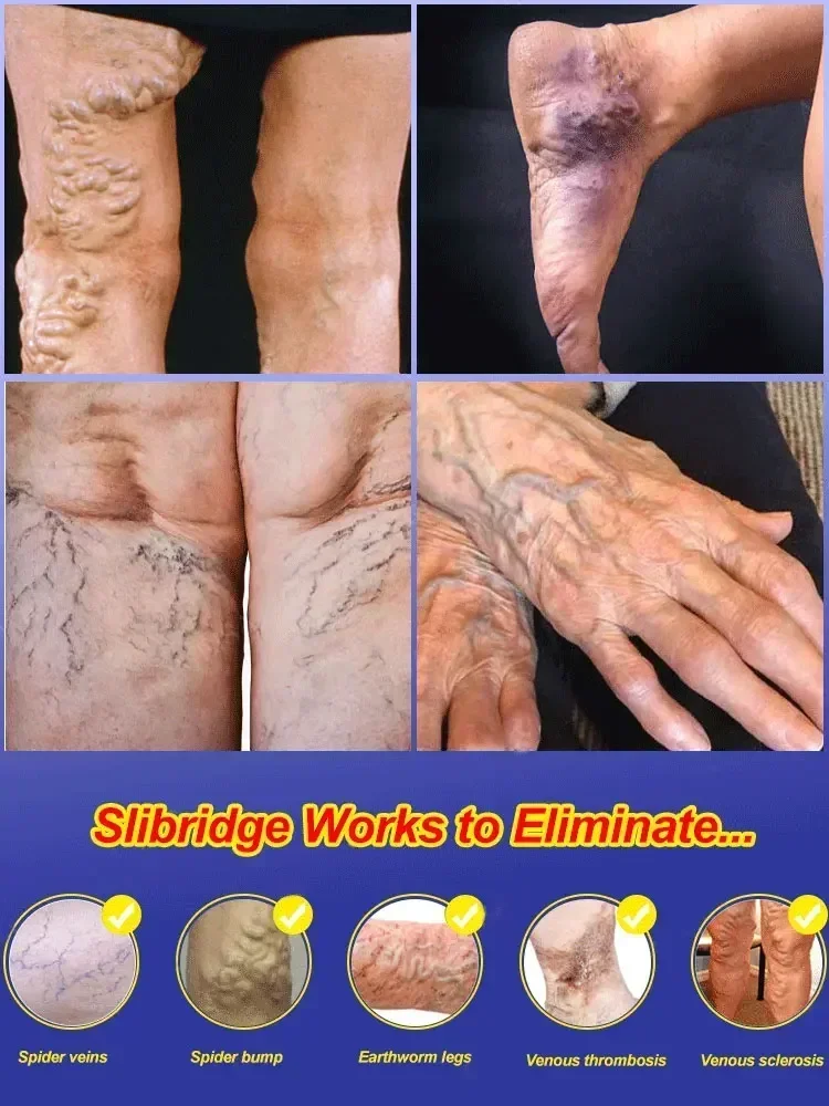 Крем против варикозного расширения вен вариусы салеп Penghilang васкутис Obat Salep крем