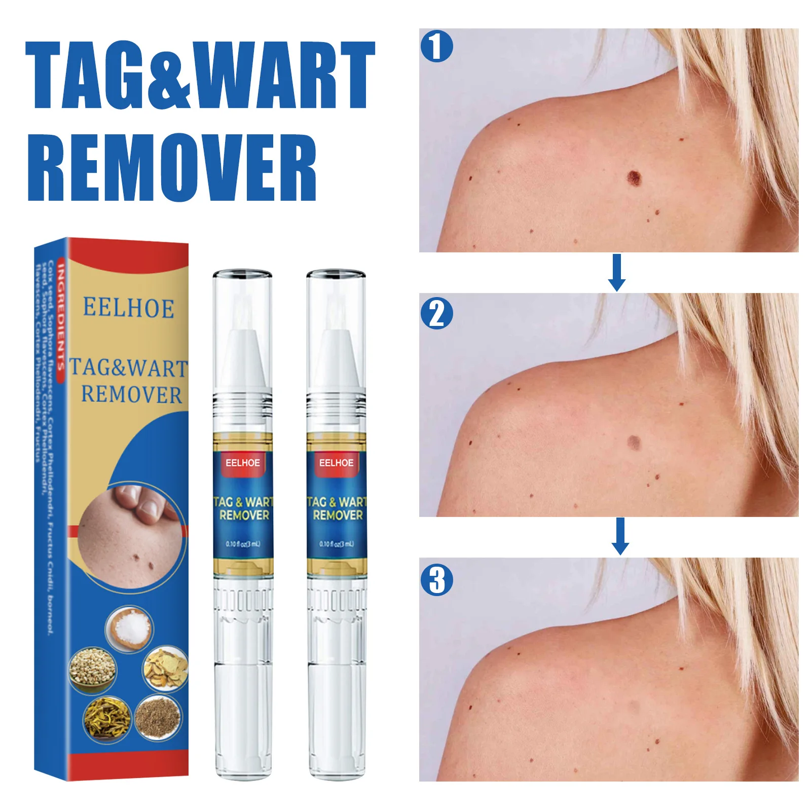 

Skin Tag Remover Against Mole & Genital Wart fast Remove Anti Foot Corn Removal Warts Papillomas Rapidly removes moles