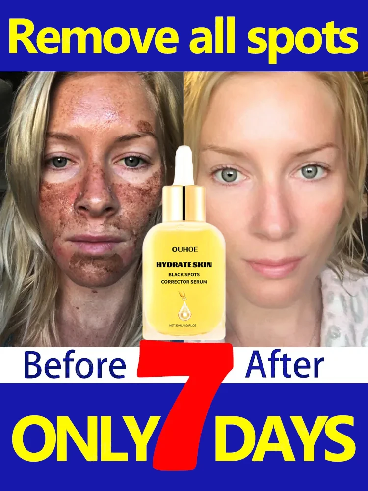 

Niacinamide Whitening Freckles Serum Remove Dark Spots Melasma Improve Dull Skin Anti-Aging Correcting Facial Beauty Skin Care