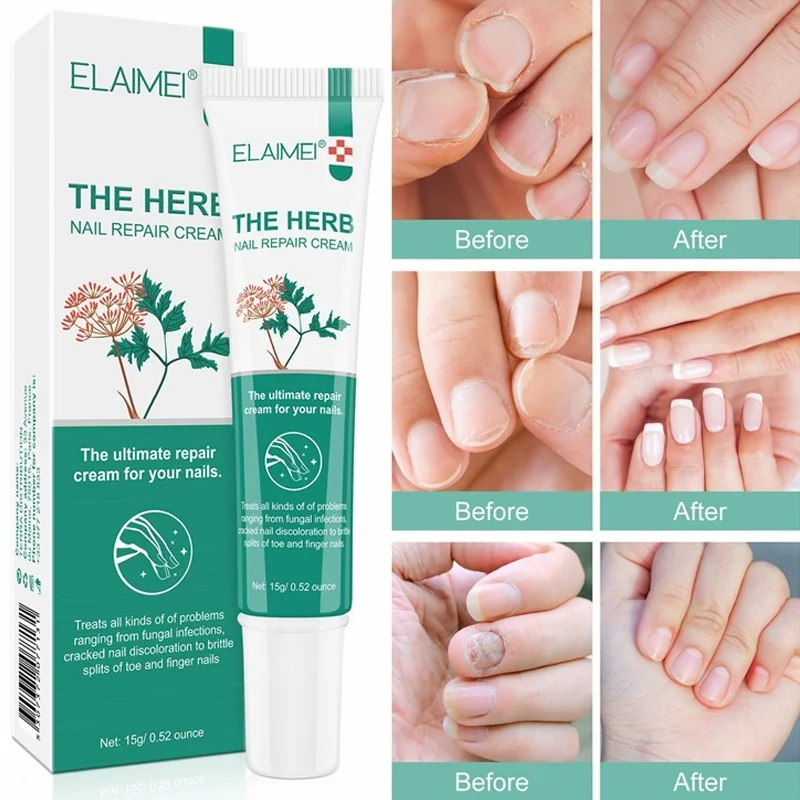 Armor Cream Remove Onychomycosis Nourishing Nail Piece Bright Nail Treatment Paronychia Antibacterial Infection Repair Ointment