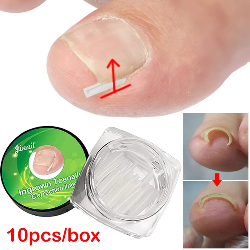 

10pcs/box Ingrown Toenail Correction Straightening Clips Paronychia Correction Toe Nail Treatment Patch Brace Pedicure Tools