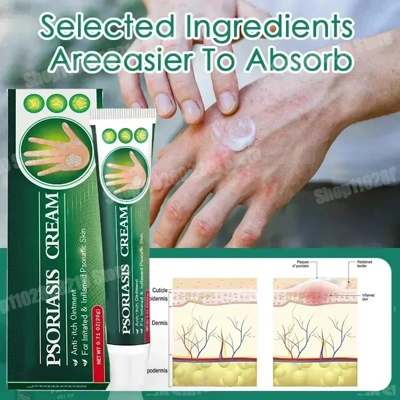Антибактериальный крем от псориаза дерматита экзематоида эффективные средства