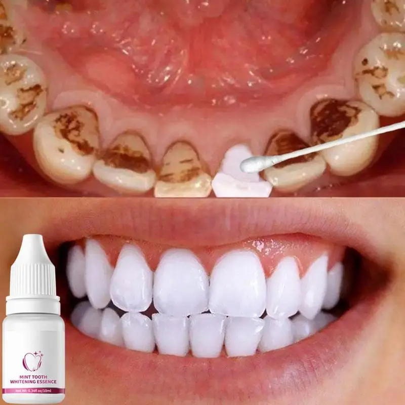 

Teeth Whitening Essence Multi-Uses Teeth Whitening Essence Removing Years Of Stubborn Stains High-quality Teeth Essenence