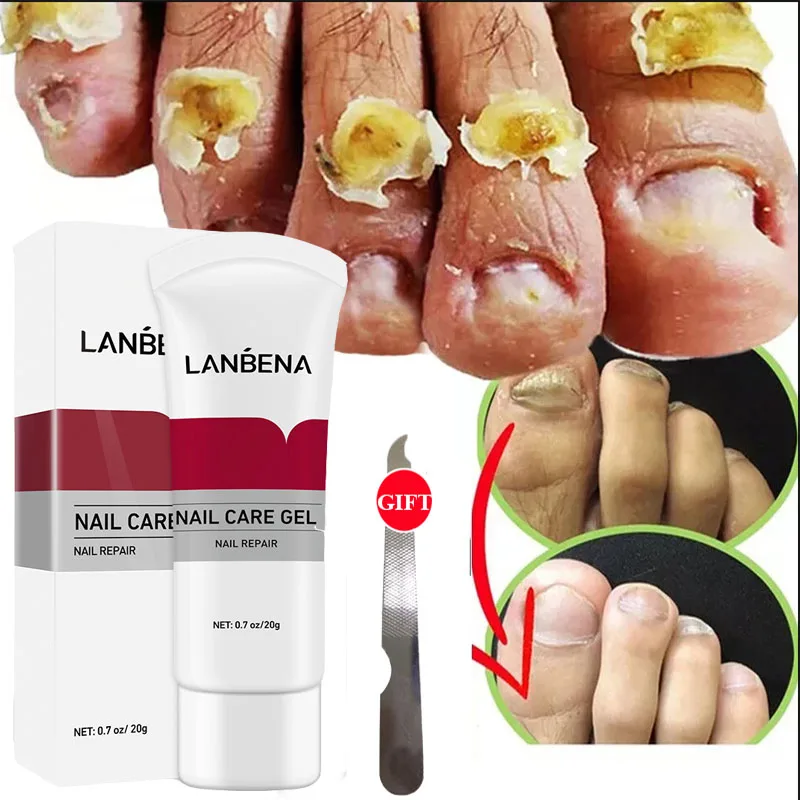 

LANBENA Fungal Nail Repair Gel Paronychia Onychomycosis Treatment Fungus Removal Anti-infective Nourishing Hand Foot Nail Care