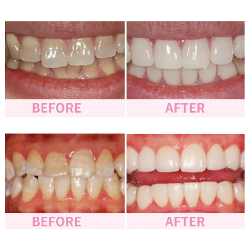 Умные чистящие салфетки для зубов удаление зубного налета пятен наноластик