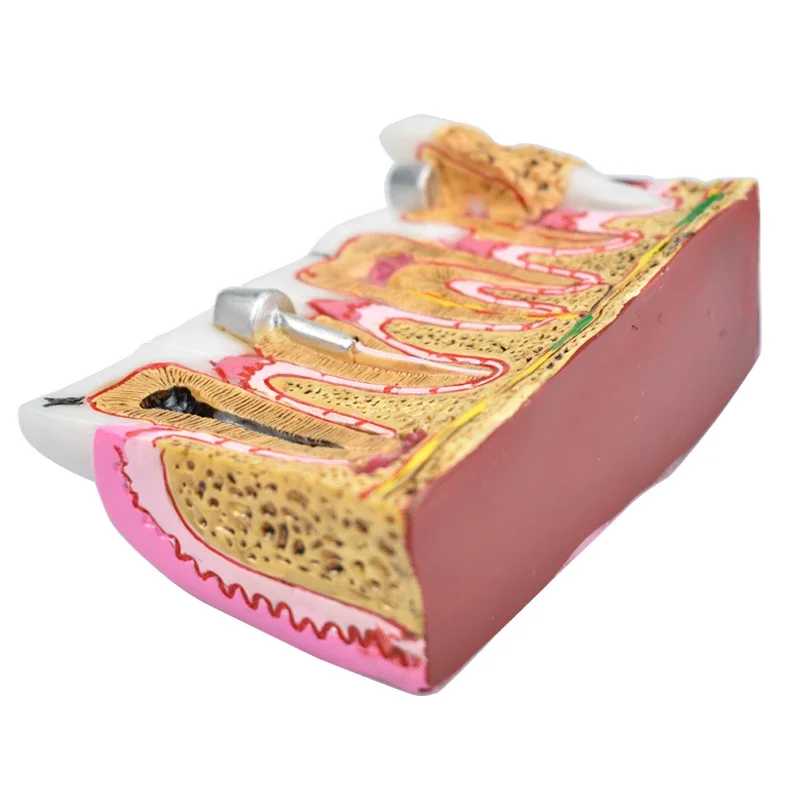 Зубные кариесы анатомия комплексная патология нерв для устного обучения модель