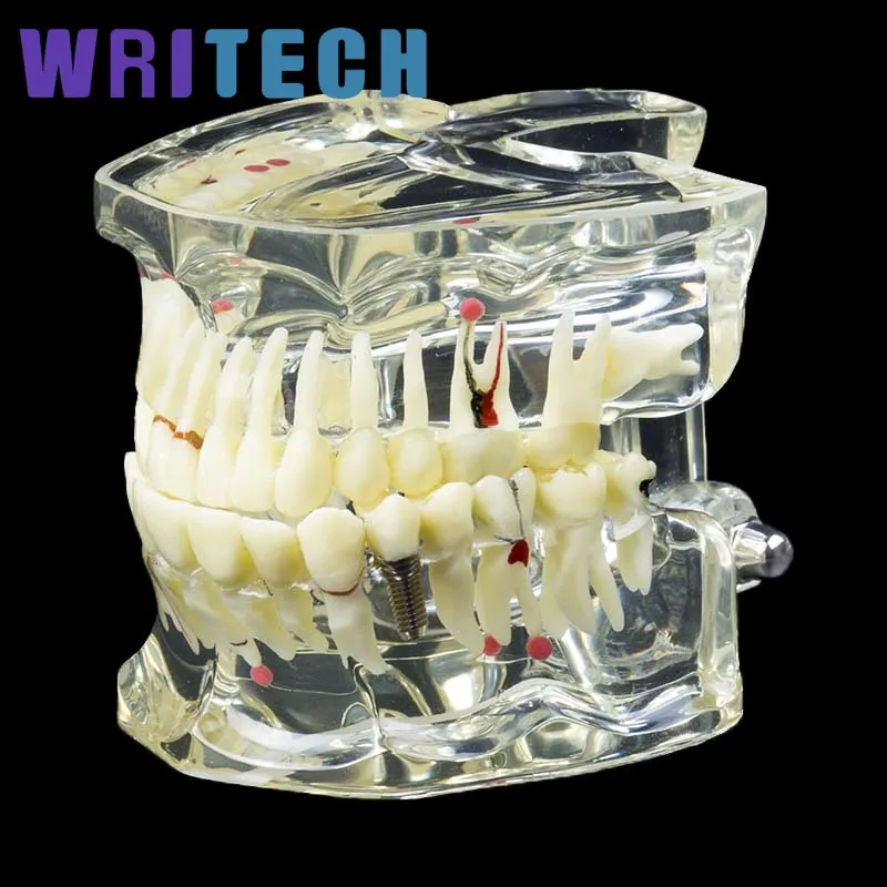 Стоматологическая прозрачная Ортодонтическая модель зубов используемая для