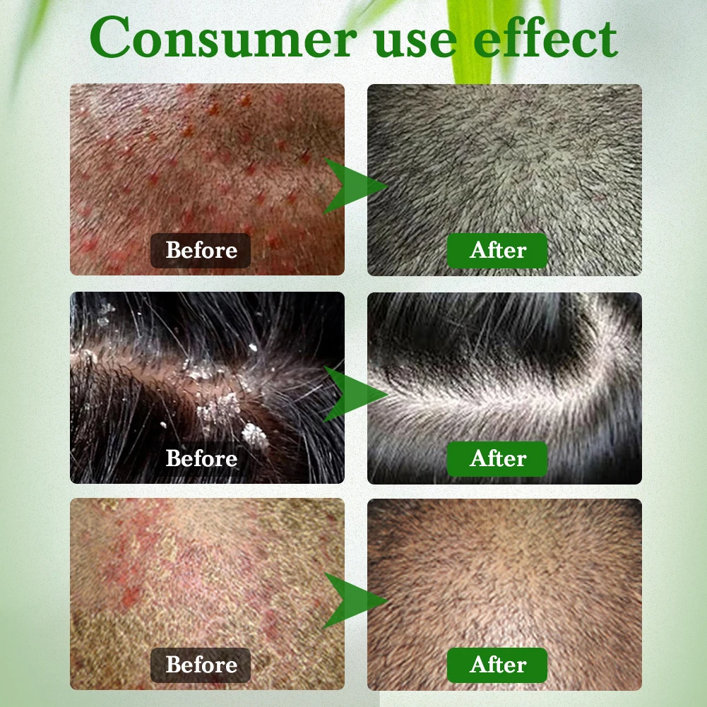New Zudaifu Herbal Ginseng Keratin Hair Shampoo Treatment Psoriasis Eczema Dermatitis Seborrheic Repair Care 300ml | Красота и