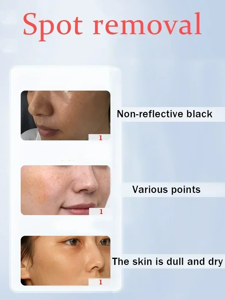 Крем для отбеливания и удаления веснушек удаляет темные пятна хлоазму