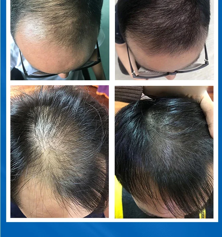 Профессиональный диодный лазер шлем для роста волос инфракрасная терапия