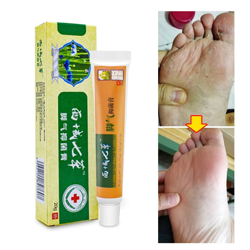 

20g Skin Beriberi Antibacterial Cream Foot Odor Foot Sweat Dermatitis Acne Skin Moss Water Bubble Peeling Skin Itching Cream