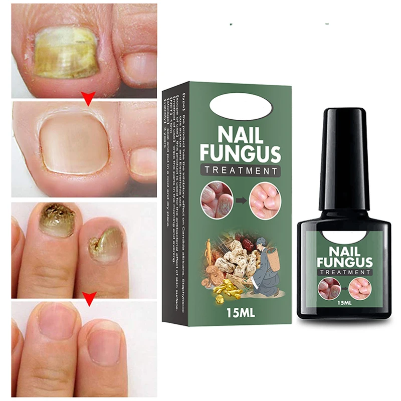 

Средство для лечения Ногтей от грибков жидкость для удаления грибка ногтей питательная против паронихии онихомикоза восстановление ног от грибков для ногтей