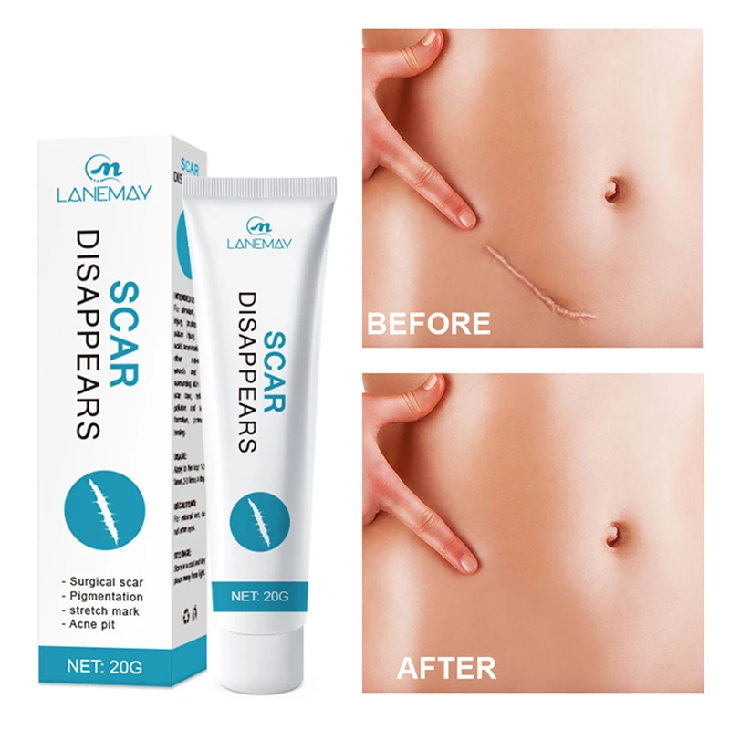 

Scar Removal Cream Repair Stretch Marks Burn Acne Surgical Acne Scar Ointment Smooth Repair Herbal Treatment Cold Compress Gel