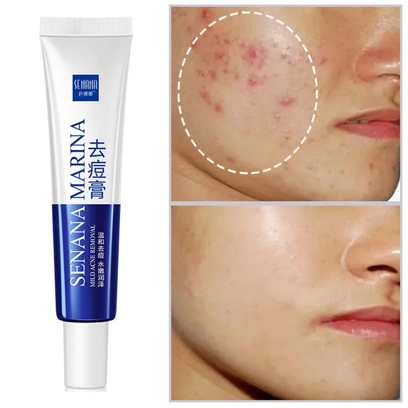 

Gel Acne Removal Cream Aloe Anti-Acne Shrink Pores Oil Control Removal Brighten Whitening Moisturizing Face Skin Care Beauty 30g