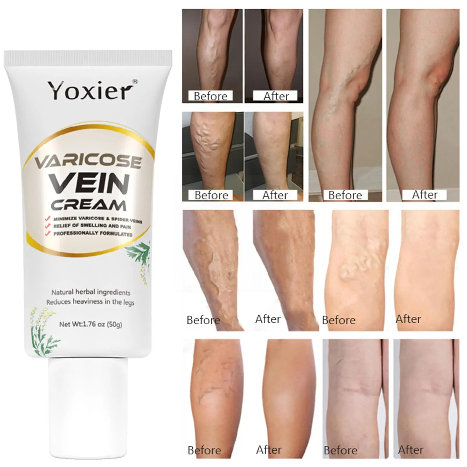 

Varicose Veins Relief Cream Vasculitis Phlebitis Spider Relief Herbal Pain Care Plaster Soothing Ointment Leg Body Medical F1G6