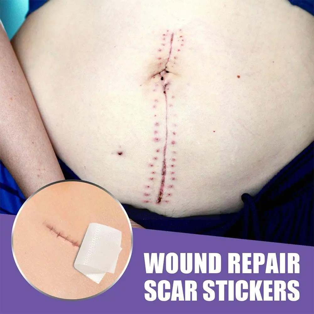 

1 roll Efficient Surgery Scar Removal Silicone Gel Sheet Therapy Patch for Acne Trauma Burn Scar Skin Repair Scar Treatment Q7H7