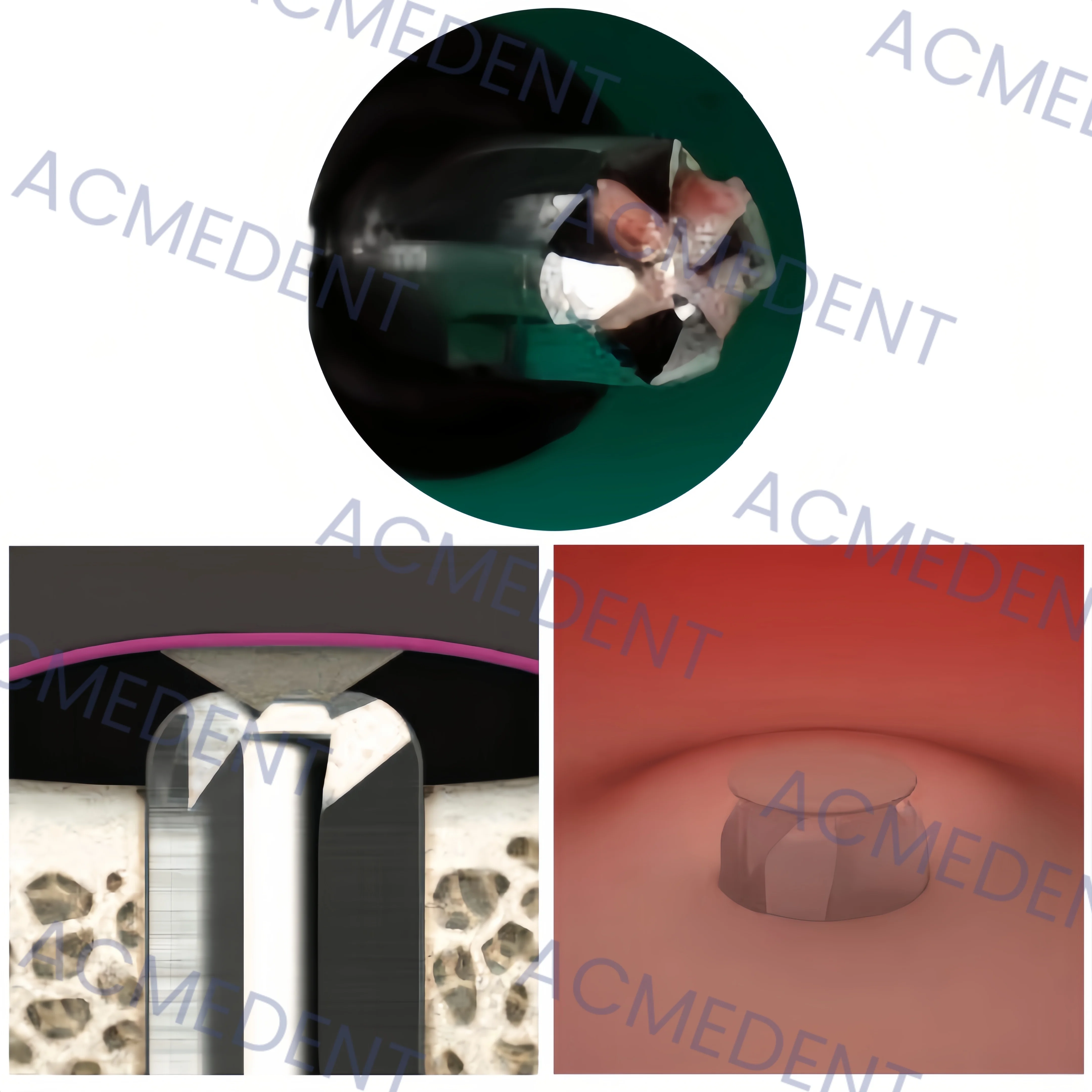 ⌀ 4.0 Стоматологическая дрель CAS с одной направляющей мембранные подъемные сверла