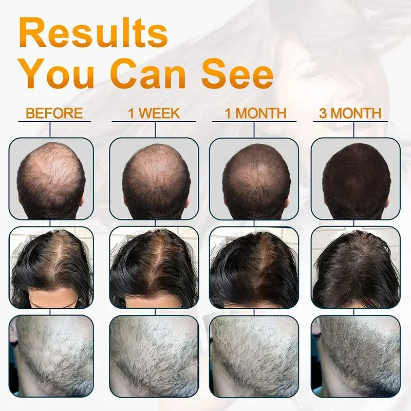 2024 Biotin быстрое масло для роста волос aHair Сыворотка восстановления истончение