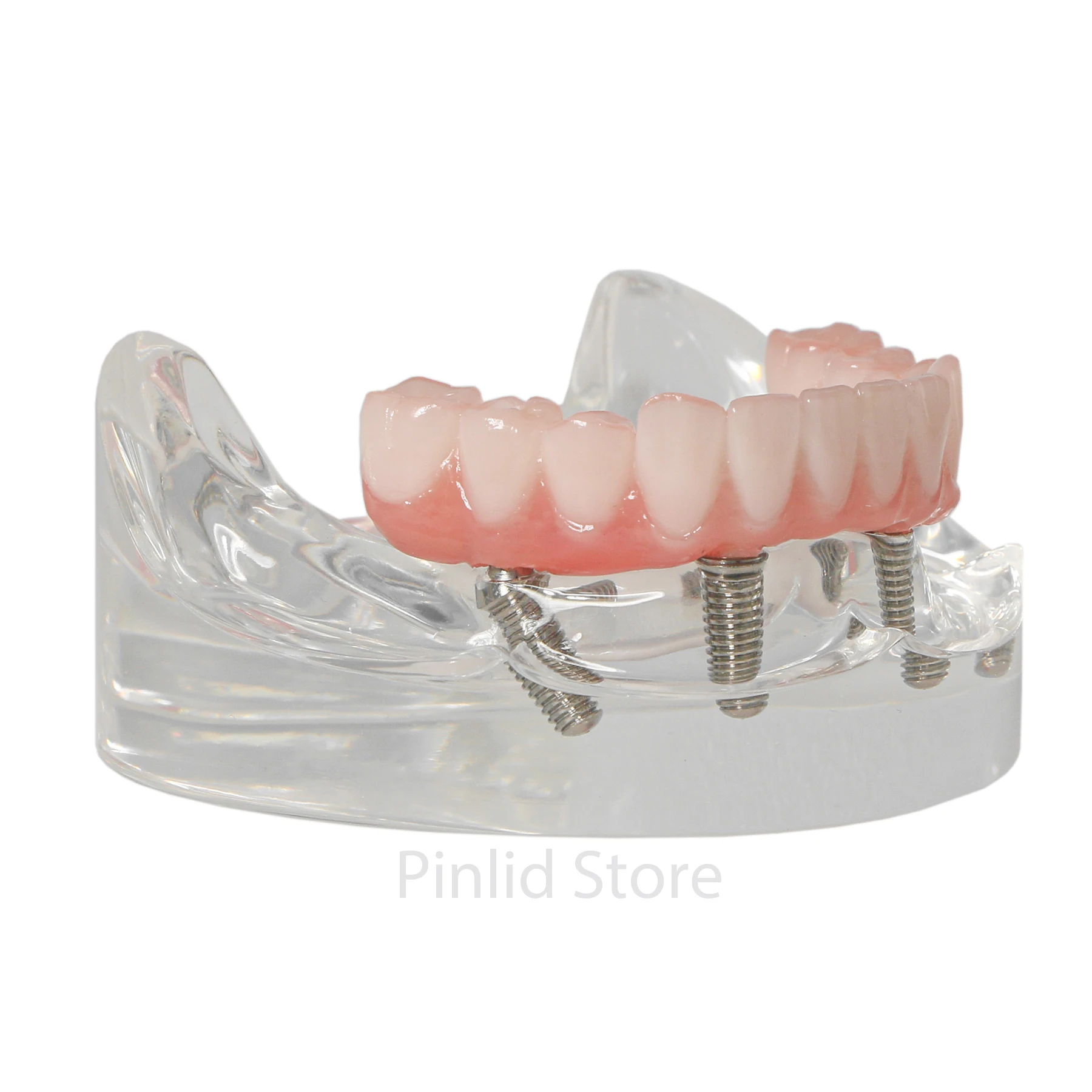 Стоматологическая модель реставрации нижнего имплантата 4 съемных винта с