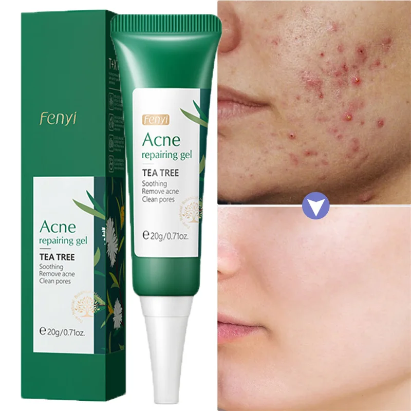 

20ml Herbal Acne Treatment Cream Effective Fade Spots Repair Gel Oil Control Shrink Pores Moisturizing Whitening Face Care
