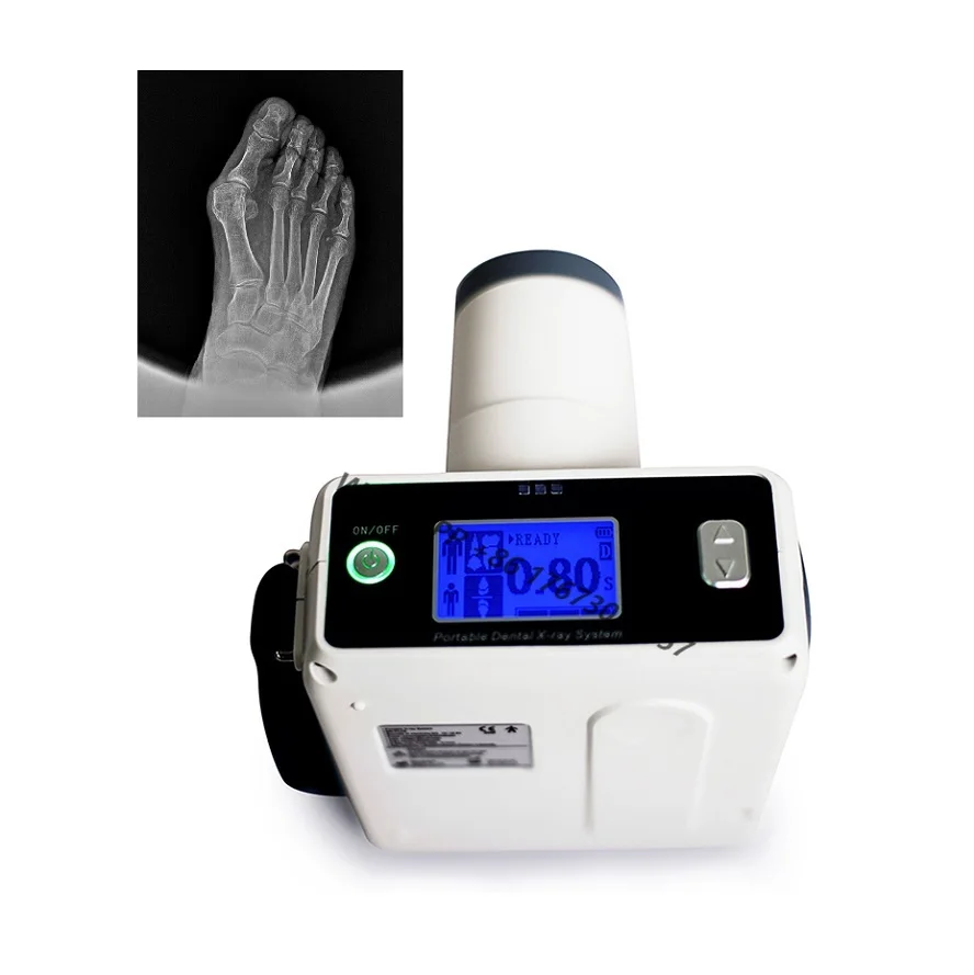 

2mA Portable X-Ray machine for foot, foot x ray 60kv
