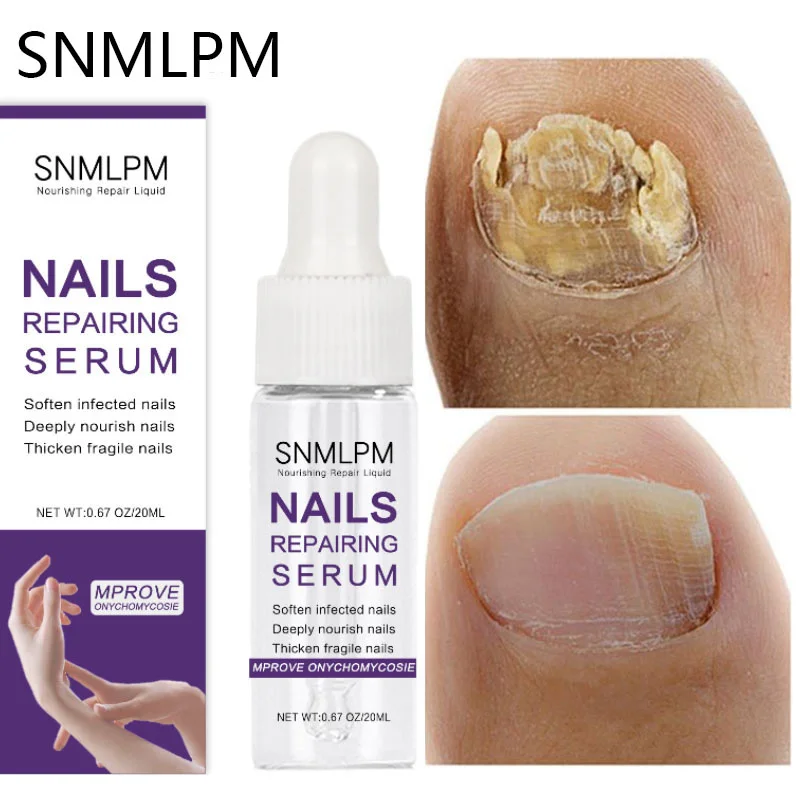 

Nail Fungal Treatment Serum Anti-Infective Remove Paronychia Onychomycosis Toe Nail Fungus Repair Essence Foot Care Product 20ml