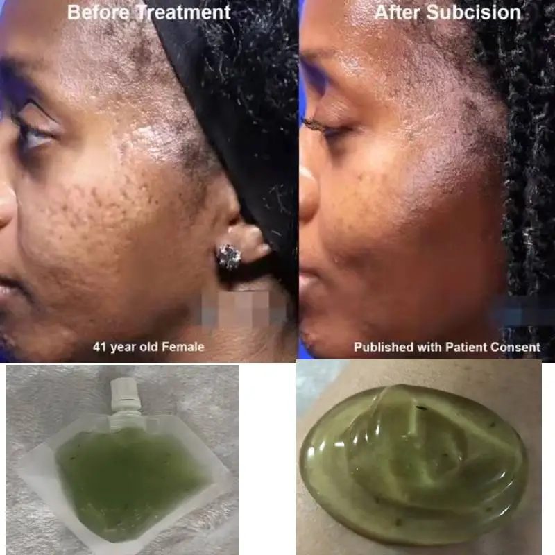 

Face Pimple Scar Acne Mark Spots Removal Treatment Gel Ointment Blemish Cream
