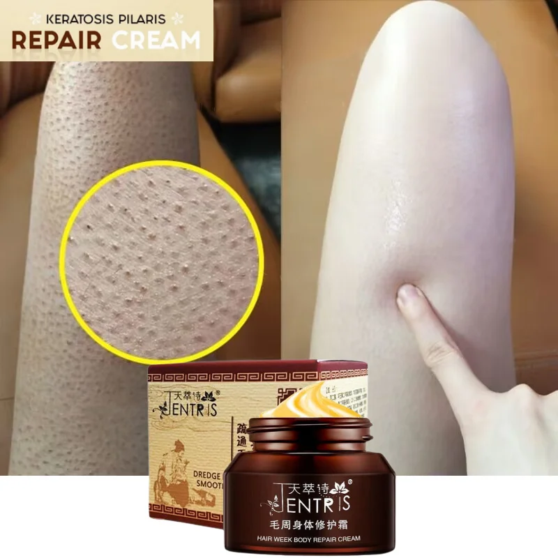 

Curing Keratosis Pilaris Repair Cream Chicken Follicle Skin Body Scrub Exfoliator Dark Spot Remove Skin Care Essence Products
