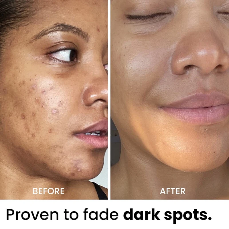 Маска для лица с витамином С куркума акне темные пятна удаление отшелушивающее